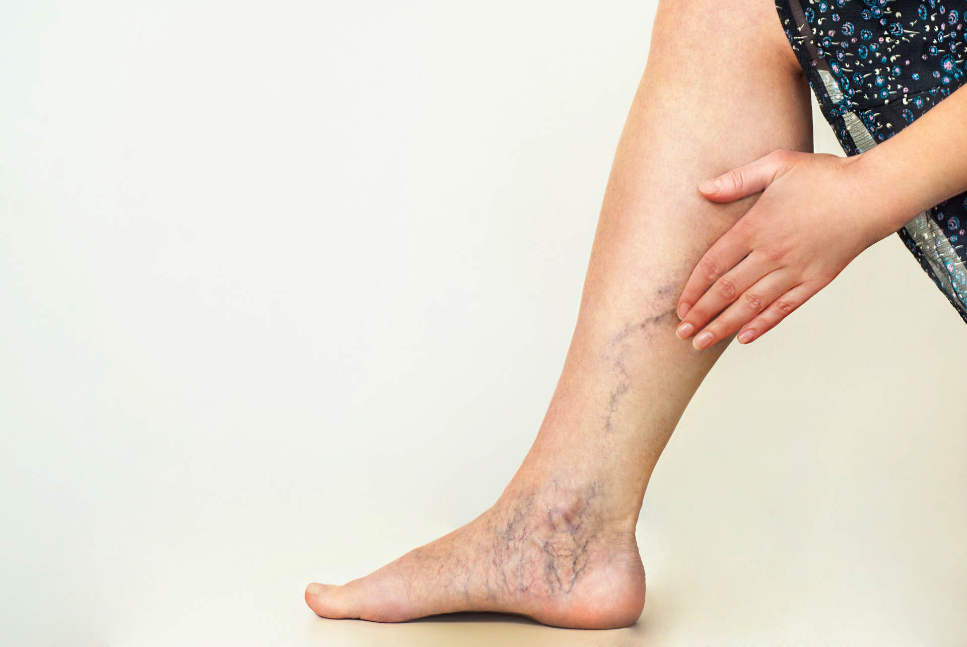 Waxing Krampfadern
